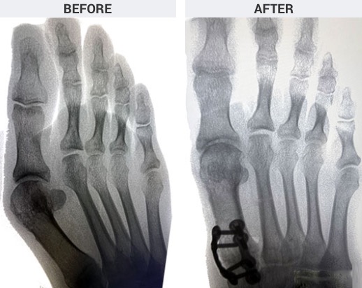 Lapiplasty Bunion Surgery, 3D Bunion Correction, University Foot And Ankle